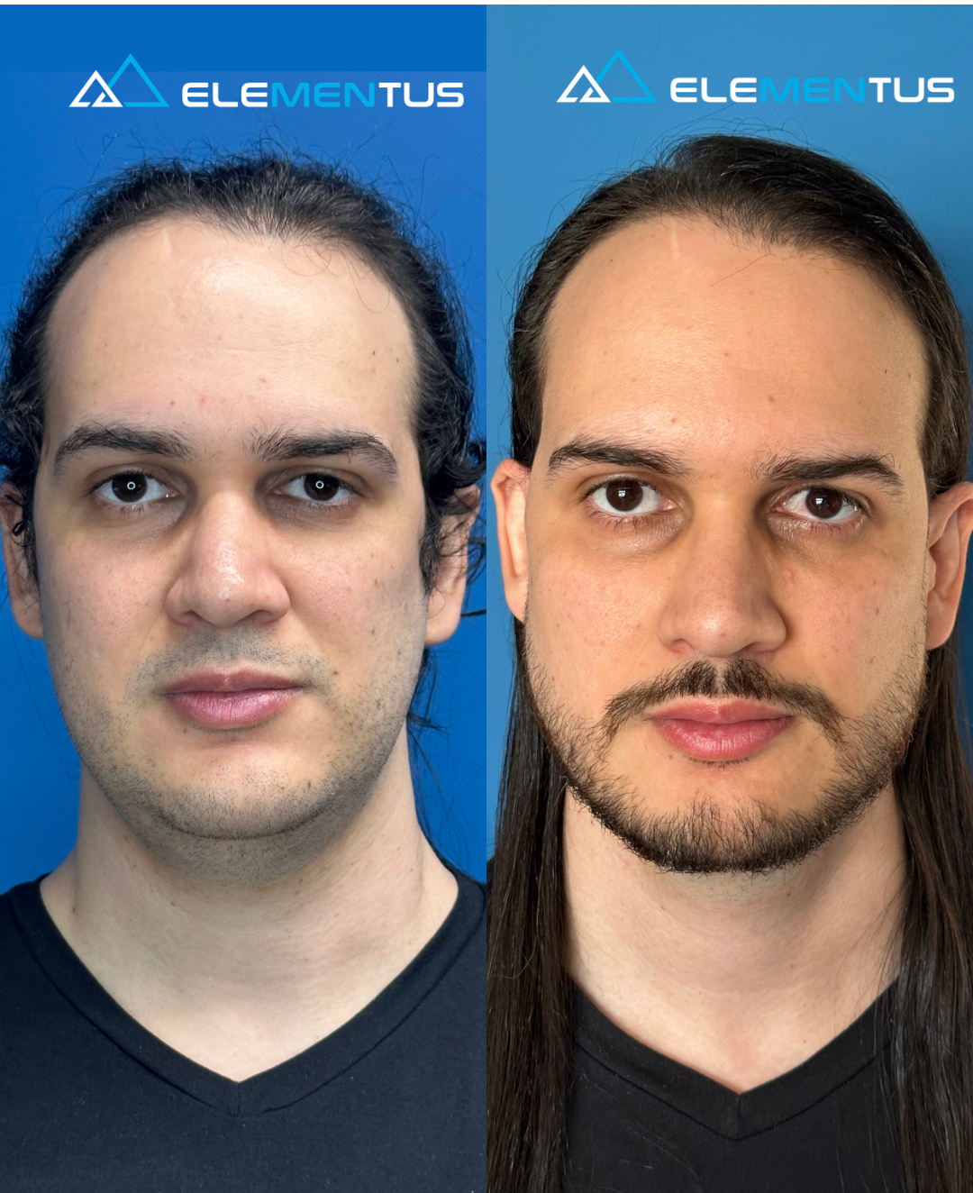 Harmonização facial