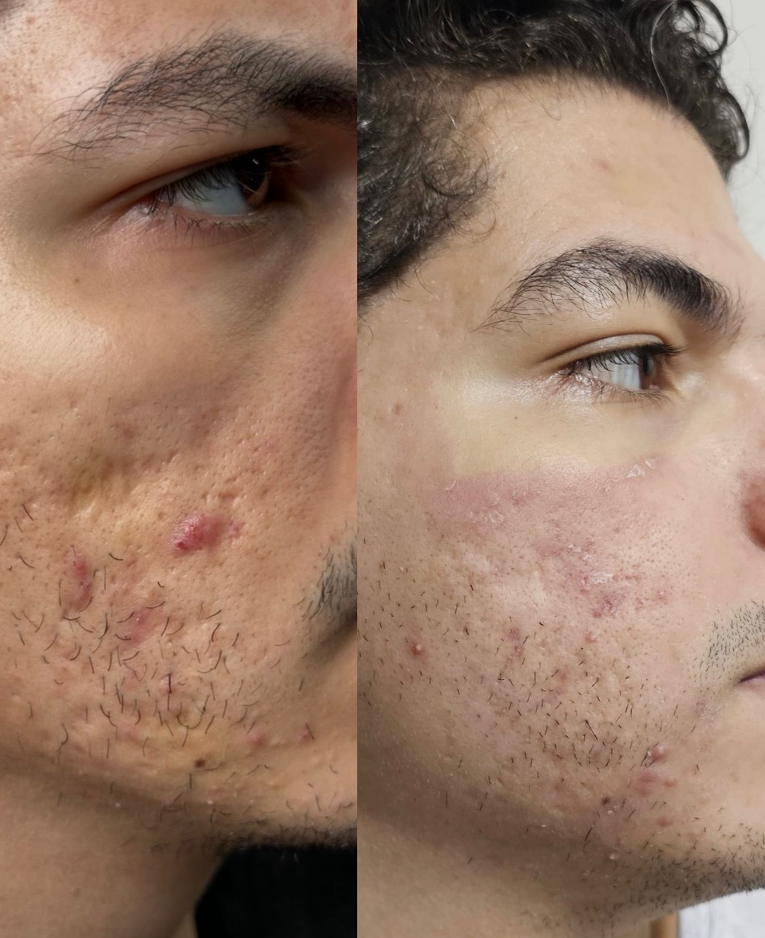 Tratamento cicatriz de acne
